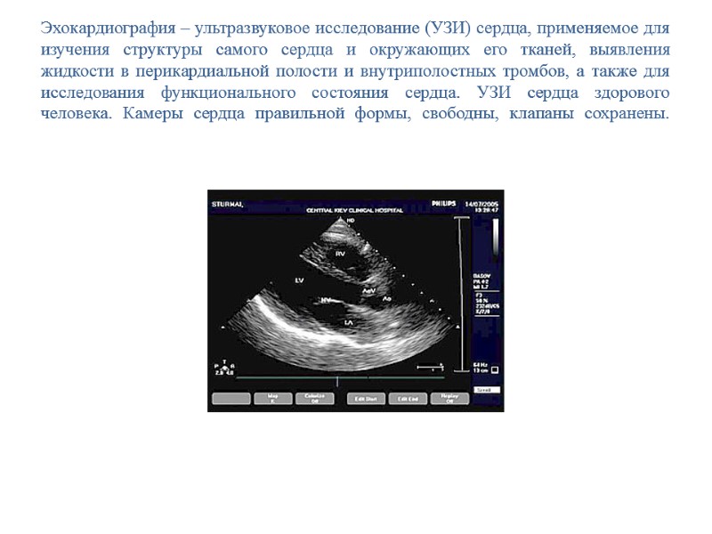 Эхокардиография – ультразвуковое исследование (УЗИ) сердца, применяемое для изучения структуры самого сердца и окружающих